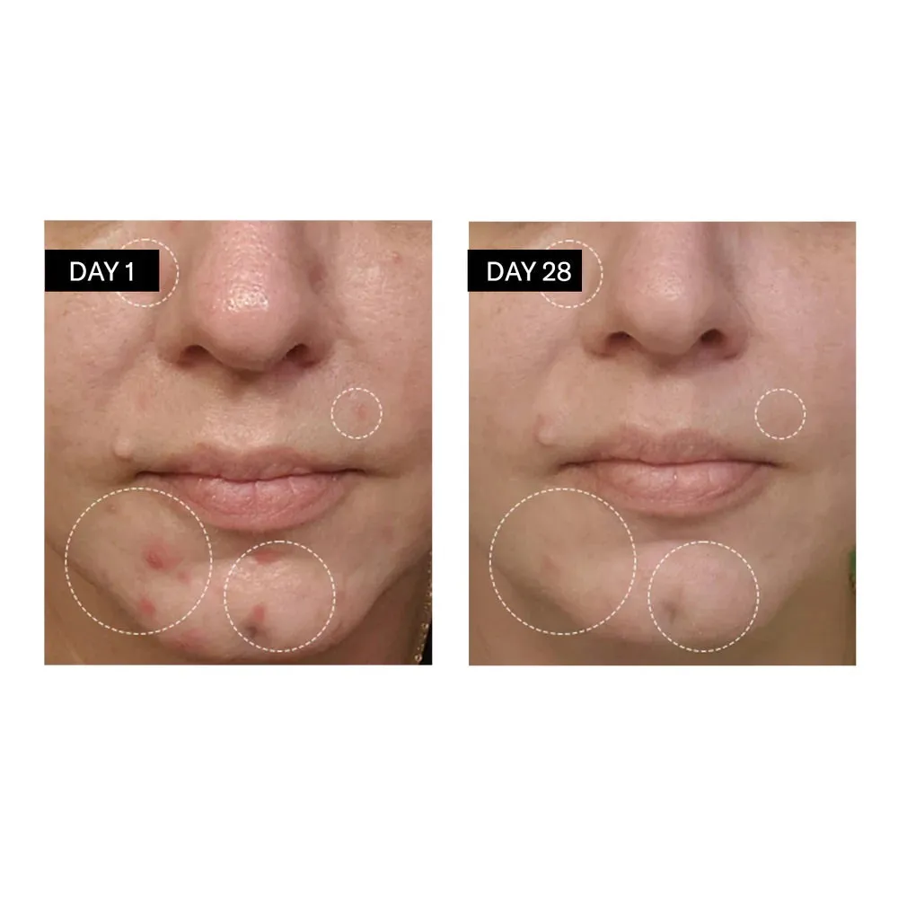 Clarifying Serum | Salicylic   Hyaluronic Acid
